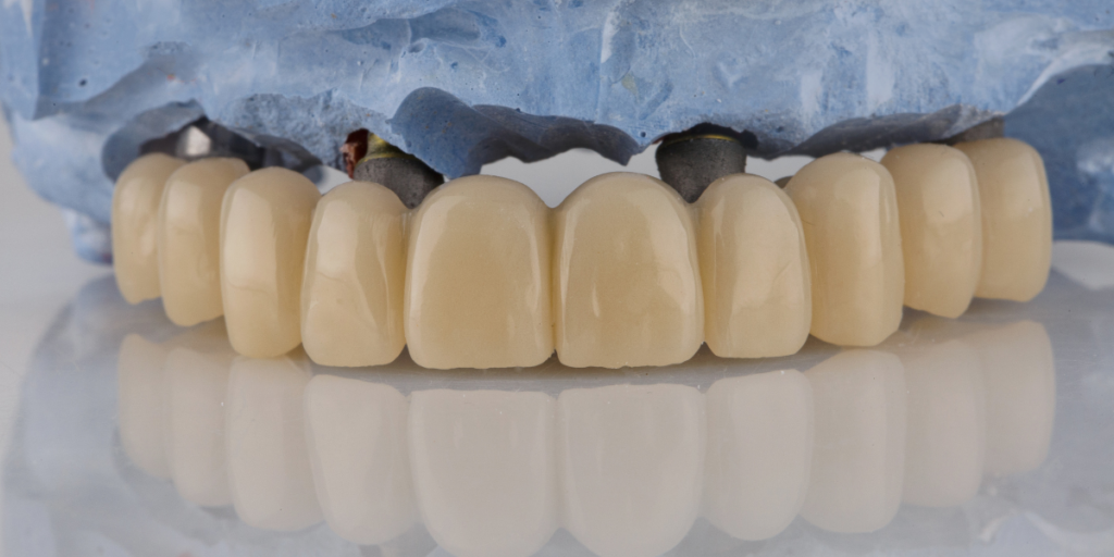 No Temporaries Required: How Same-Day Crowns Streamline Restorative Care