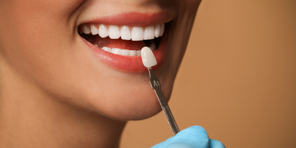 How Much Do Veneers Cost? Longevity, Materials, and Financing Options