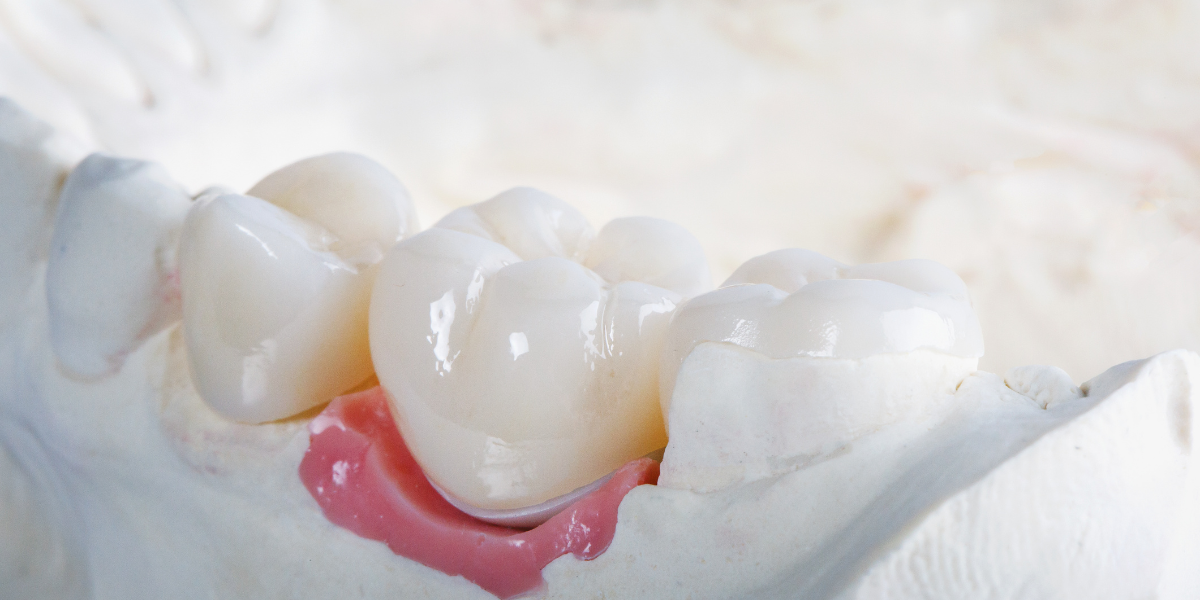 What are same-day crowns, and why are temporaries not required?