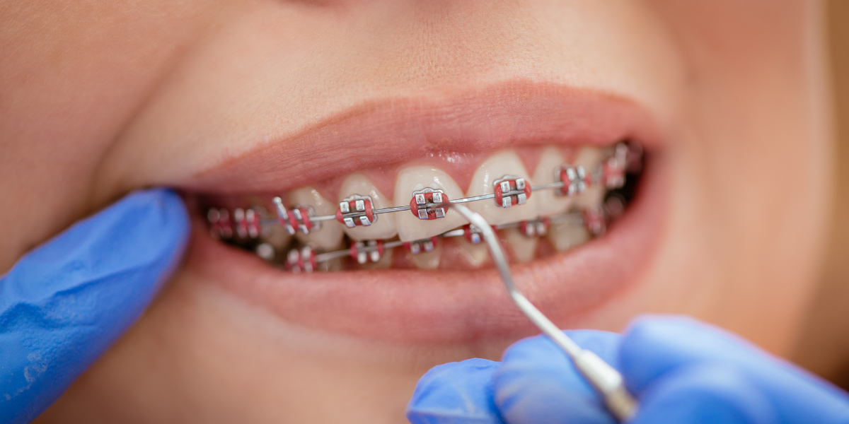 Am I Too Old for Braces? Why More Adults Are Visiting the Orthodontist