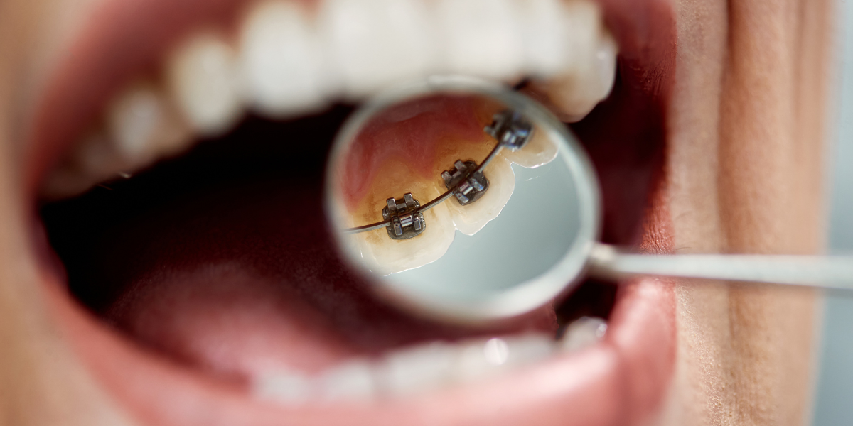 Are Braces Different for Adults Than for Teenagers?