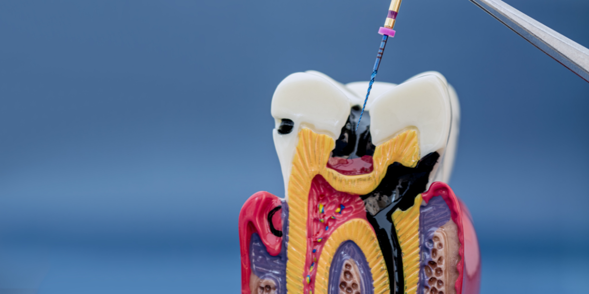 A Root-Canal-Treated Tooth Still Hurts When I Bite—Is It the Bite, a Crack, or a Persistent Infection?