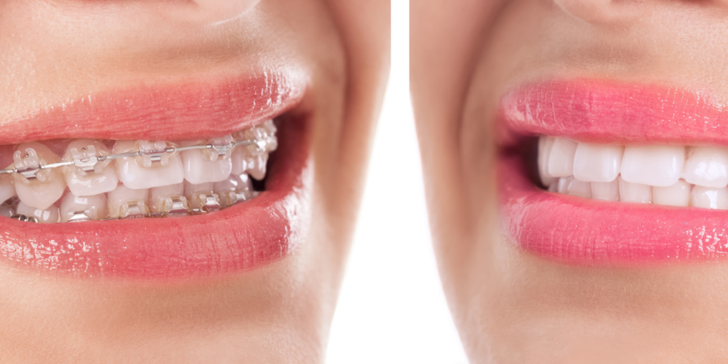 My Open Bite Came Back After Braces—When Tongue Posture Must Be Addressed Before Retreatment