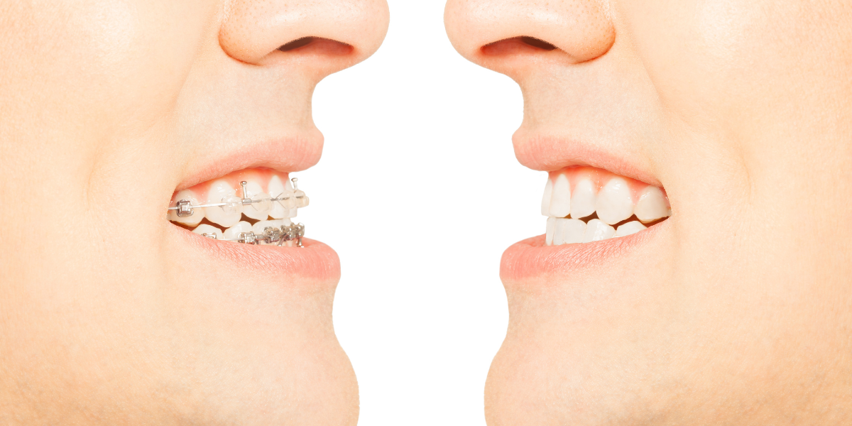 Why an open bite can return after braces