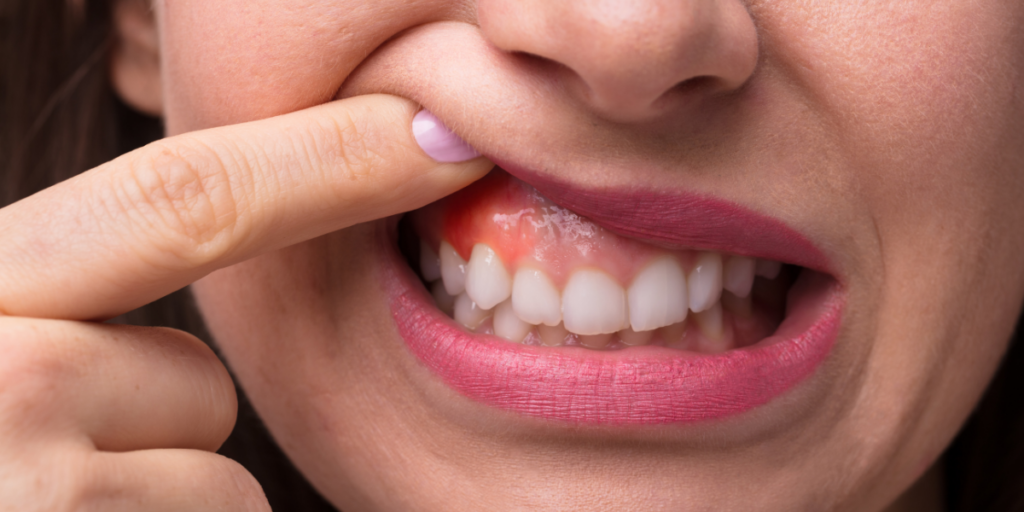 3. Gums That Frequently Bleed, Swell, or Feel Tender