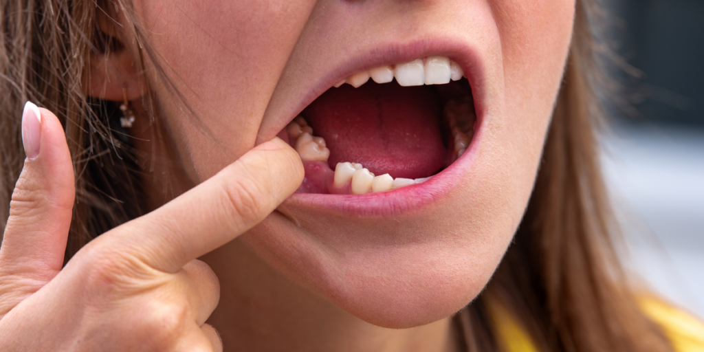 4. A Chipped, Cracked, Broken, or Loose Tooth