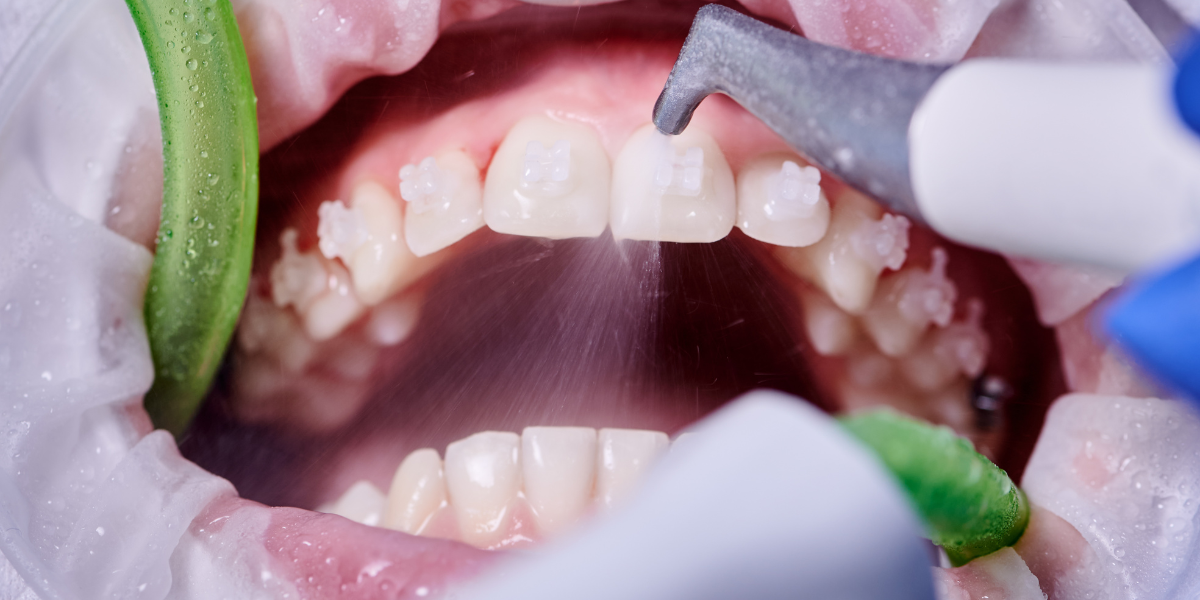 At-Home Care vs. Professional Dental Cleaning: Why You Need Both