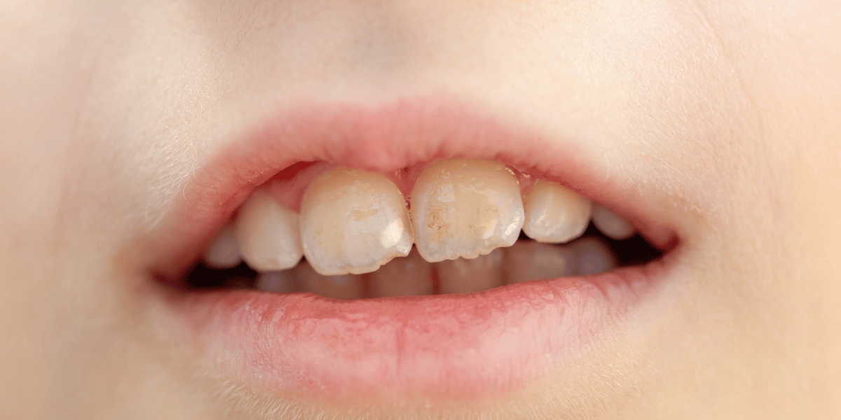 Fluorosis and White Spots: Can Teeth Whitening Even Out Your Smile?