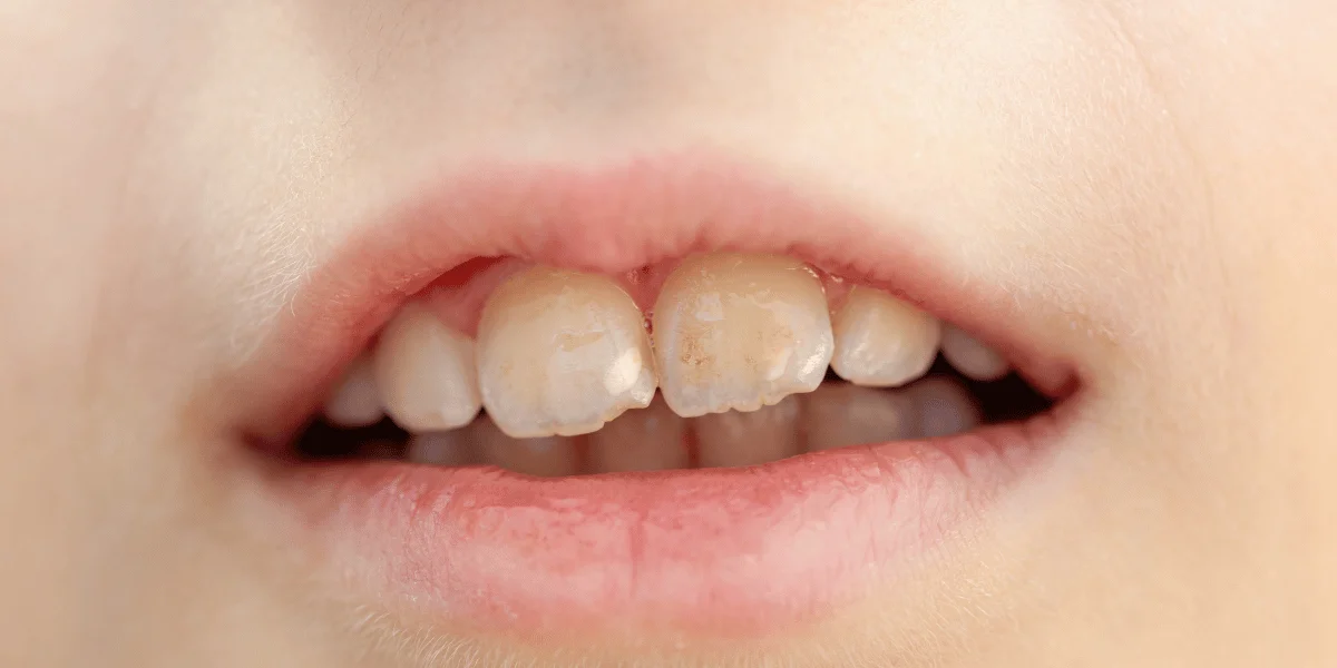 Fluorosis and White Spots: Can Teeth Whitening Even Out Your Smile?