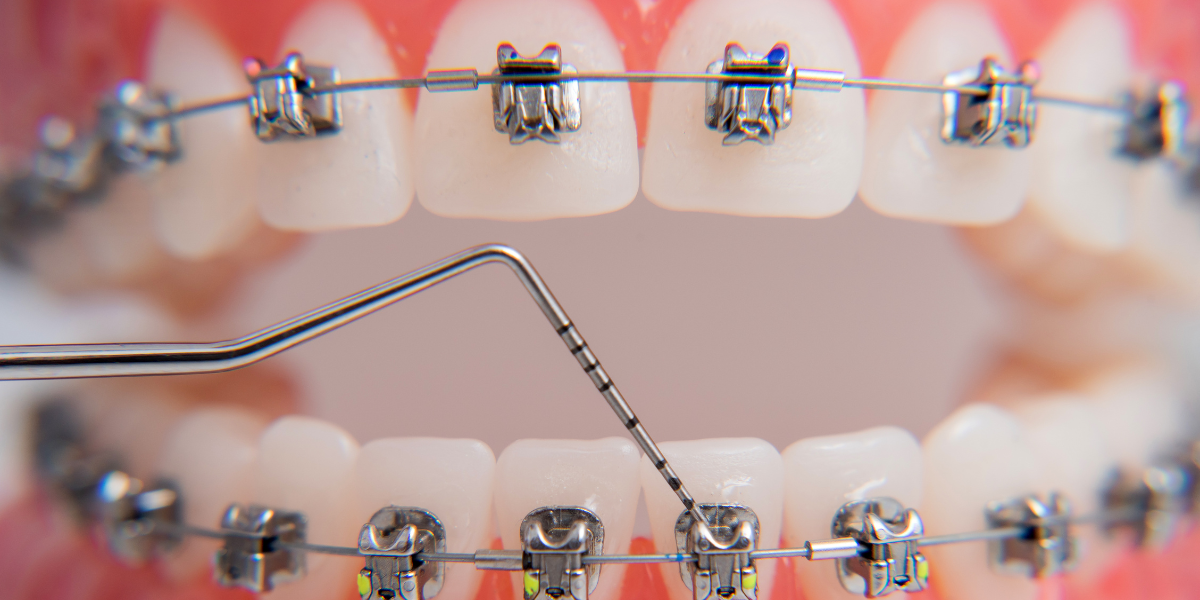 How Brackets and Wires Move Teeth
