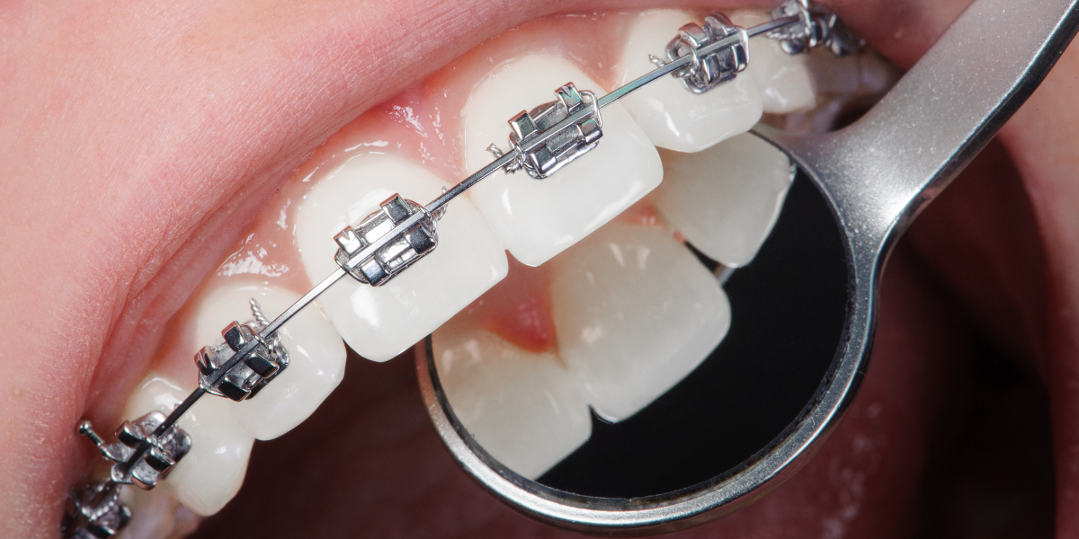 Metal vs. Ceramic Braces in Clifton: Understanding Your Orthodontic Options