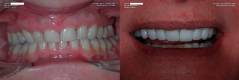 Porcelain veneers without tooth preparation (lumineers)